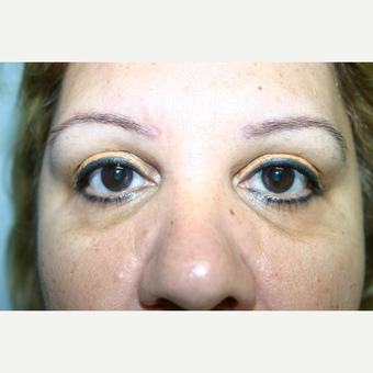 52 year old woman treated with Eyelid Surgery before 3442580