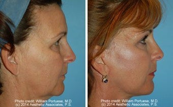 Facelift before 91425