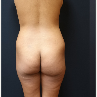 25-34 year old woman treated with Liposculpture before 3731888