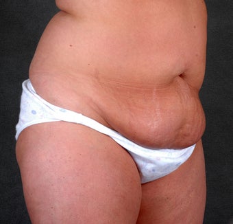 Liposuction of the Hips & Thighs 1057121