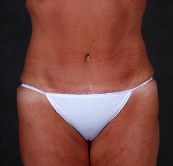 Liposuction of the Hips & Thighs after 1057121