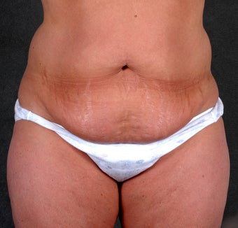 Liposuction of the Hips & Thighs before 1057121