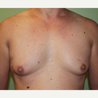 35-44 year old man treated with Male Breast Reduction before 2977762