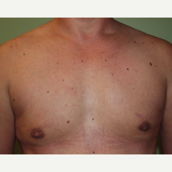 35-44 year old man treated with Male Breast Reduction after 2977762