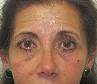 Facial wrinkles, lower lid rhytids (wrinkles) and tear trough hollows before 1032177