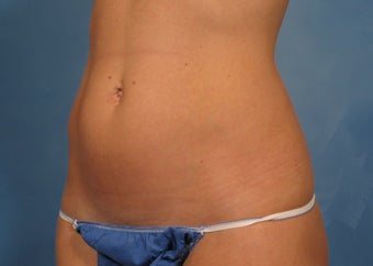 CoolSculpting by ZELTIQ before 246775
