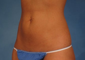 CoolSculpting by ZELTIQ after 246775