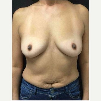 45-54 year old woman treated with Breast Augmentation before 3103473