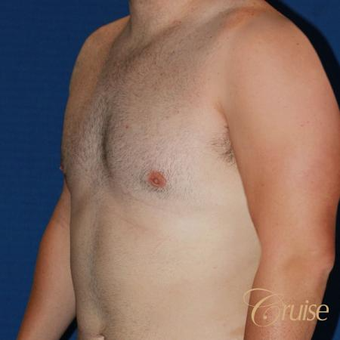 Male breast reduction surgery on a 28 year old male after 3502232