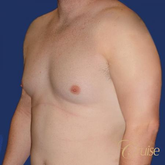 Male breast reduction surgery on a 28 year old male before 3502232
