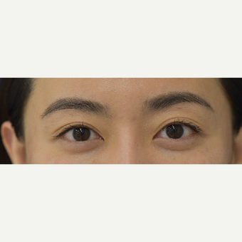 25-34 year old woman treated with Juvederm after 3488901