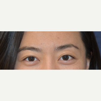 25-34 year old woman treated with Juvederm before 3488901