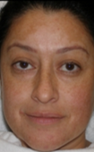 35-44 year old woman treated with Fractional Laser before 2784049