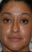 35-44 year old woman treated with Fractional Laser after 2784049