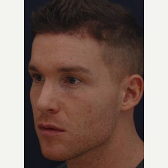 25- 34 year old man treated with Forehead Reduction (Dr. Aharonov and Dr. Pak) after 1973838
