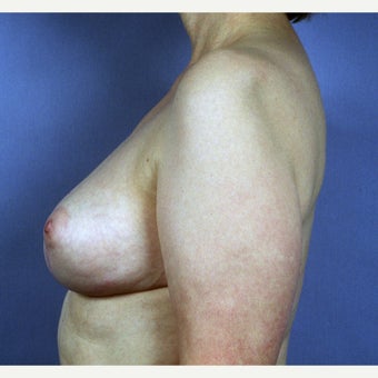 55-64 year old woman treated with Breast Implant Removal and Mastopexy (Breast Lift). 1827357