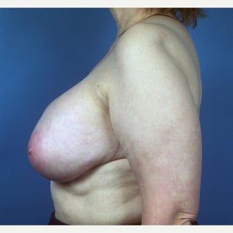 55-64 year old woman treated with Breast Implant Removal and Mastopexy (Breast Lift). 1827357