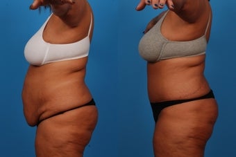 Tummy Tuck: 49-Year-Old Woman 1050745