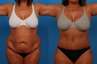 Tummy Tuck: 49-Year-Old Woman before 1050745