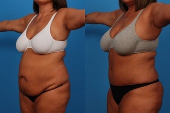 Tummy Tuck: 49-Year-Old Woman after 1050745