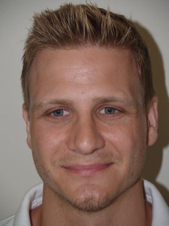 Before and After Revision Rhinoplasty 680009