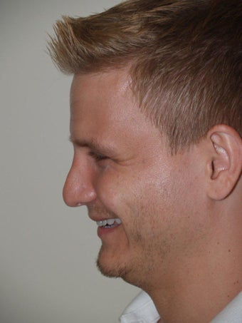 Before and After Revision Rhinoplasty before 680009