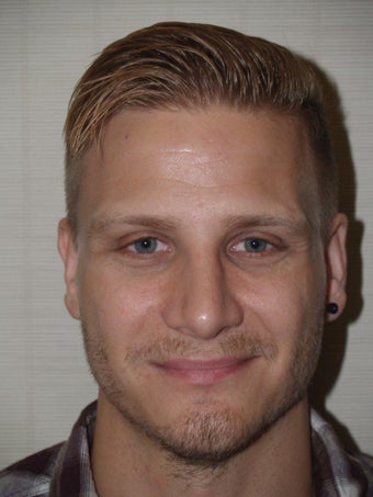 Before and After Revision Rhinoplasty 680009