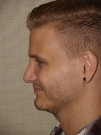 Before and After Revision Rhinoplasty after 680009