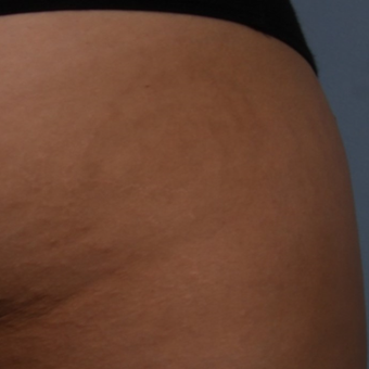 18-24 year old woman treated with Stretch Marks Treatment after 3224995