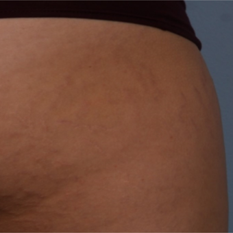 18-24 year old woman treated with Stretch Marks Treatment before 3224995