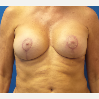 58 year old female treated with Breast Implants (Silicone) and Breast Lift after 3490184