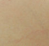 Spider vein removal with laser treatments after 106554