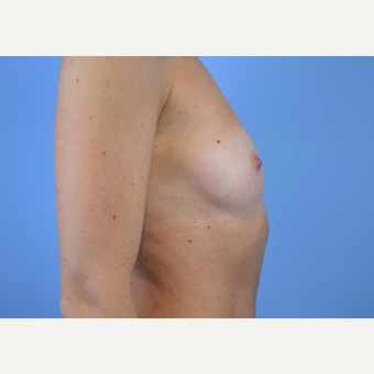 25-34 year old woman treated with Breast Implants before 3440038