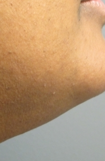 43 year old female with excess facial hair treated presented for laser hair removal after 1132533