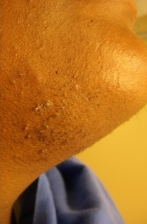 43 year old female with excess facial hair treated presented for laser hair removal before 1132533
