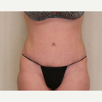 25-34 year old woman treated with Tummy Tuck after 3259033