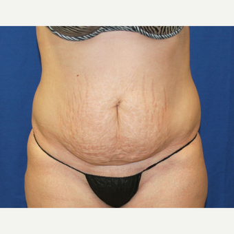 25-34 year old woman treated with Tummy Tuck before 3259033