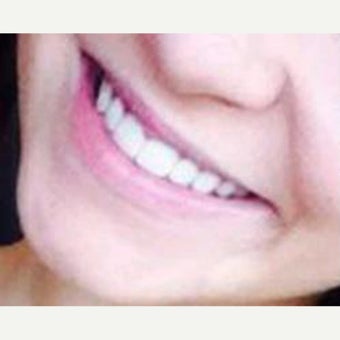 18-24 year old woman treated with Lip Augmentation before 2114632