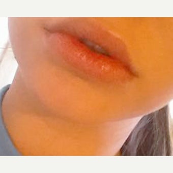 18-24 year old woman treated with Lip Augmentation after 2114632