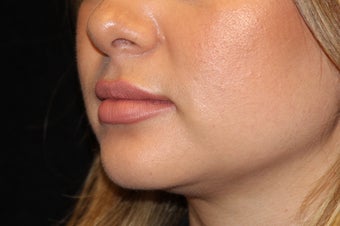 25-34 year old woman treated with Lip Augmentation 3502396