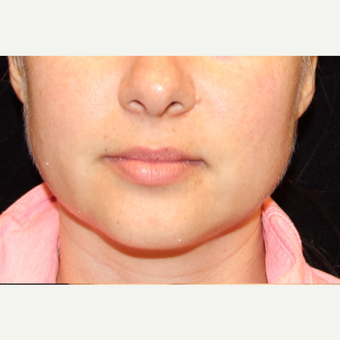 25-34 year old woman treated with Lip Augmentation before 3502396