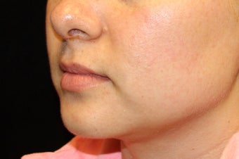 25-34 year old woman treated with Lip Augmentation 3502396