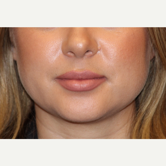 25-34 year old woman treated with Lip Augmentation after 3502396