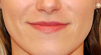 Lip Enhancement with Restylane before 1144910