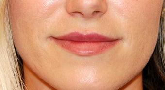 Lip Enhancement with Restylane after 1144910