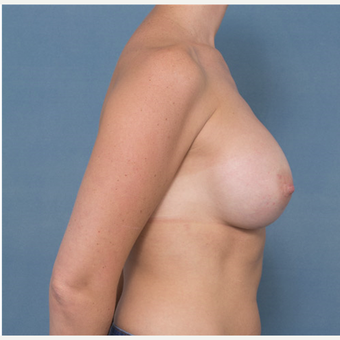35-44 year old woman treated with Breast Augmentation after 3277807