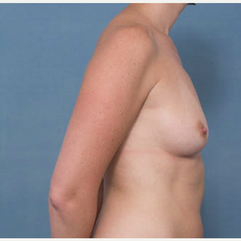 35-44 year old woman treated with Breast Augmentation before 3277807