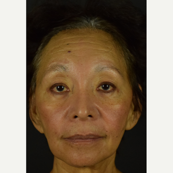 Injectable Fillers to the Midface, Smile Lines and Corners of the Mouth after 3691733