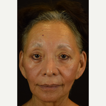 Injectable Fillers to the Midface, Smile Lines and Corners of the Mouth before 3691733