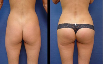 Buttocks Implants after 399986